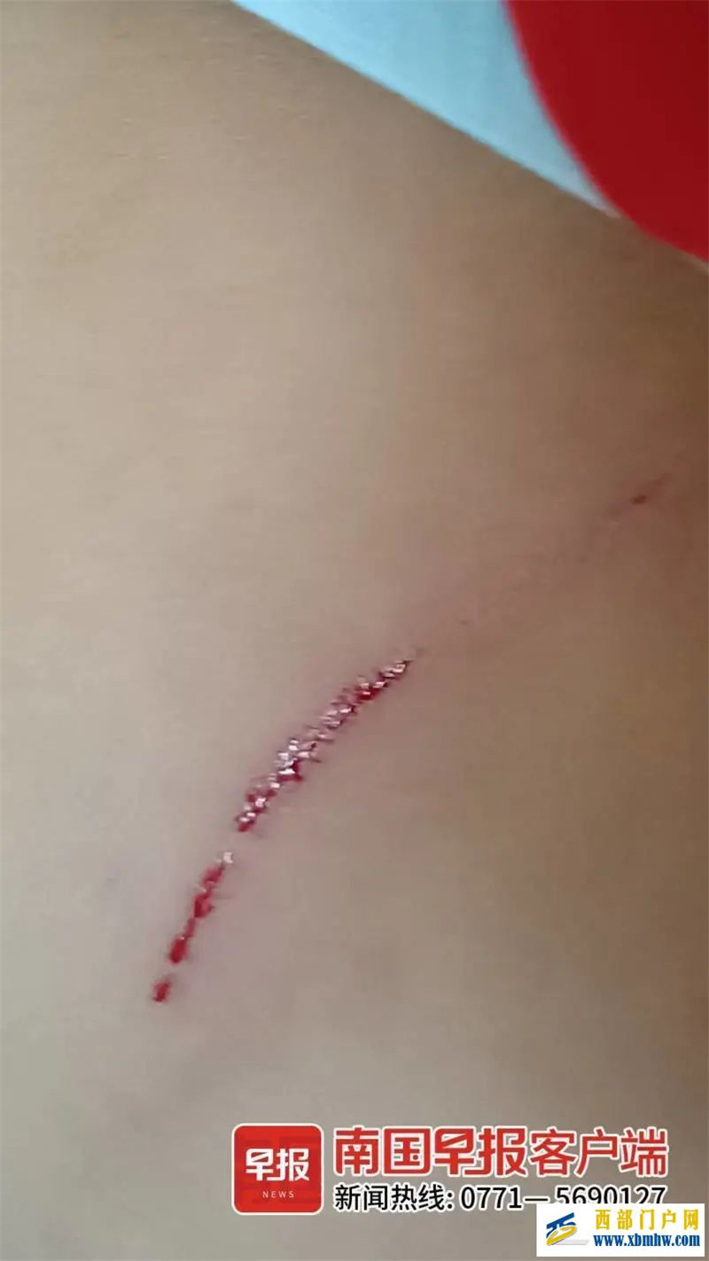 南寧一女孩背部遭受重?fù)簦议L(zhǎng)急尋目擊者(圖1) 南寧一女孩背部遭受重?fù)簦议L(zhǎng)急尋目擊者(圖1)