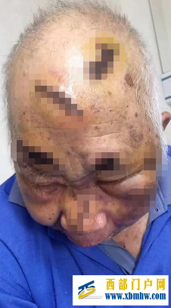宜賓79歲老人養老院內被打？回應：與另一老人在醫院起紛爭受傷(圖1)